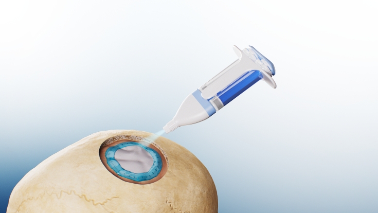 封閉防漏黑科技——睿固?硬腦膜醫用膠